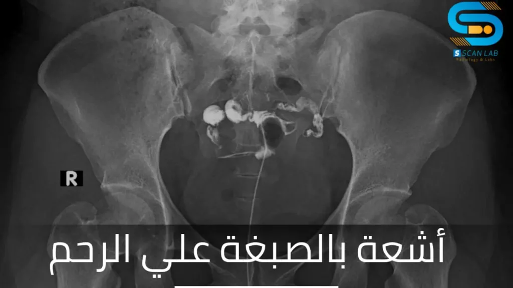 كم سعر أشعة الصبغة على الرحم والأنابيب؟ 